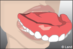 La prothese amovible