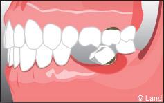 Pour remplacer les dents manquantes