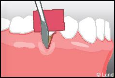 Chirurgie mucogingivale